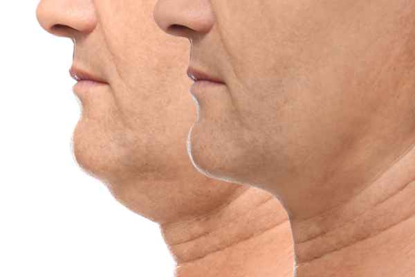 HIFU - Breakthrough in Anti - ageing 2 hifu results Bournemouth