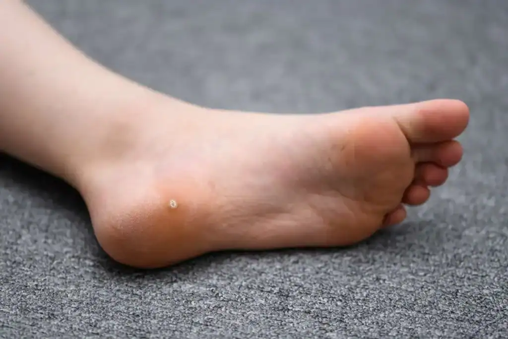 Cryotherapy For Warts And Also Verrucas 2 Image of verruca on the bottom of the foot that able to be treated with Cryotherapy Bournemouth