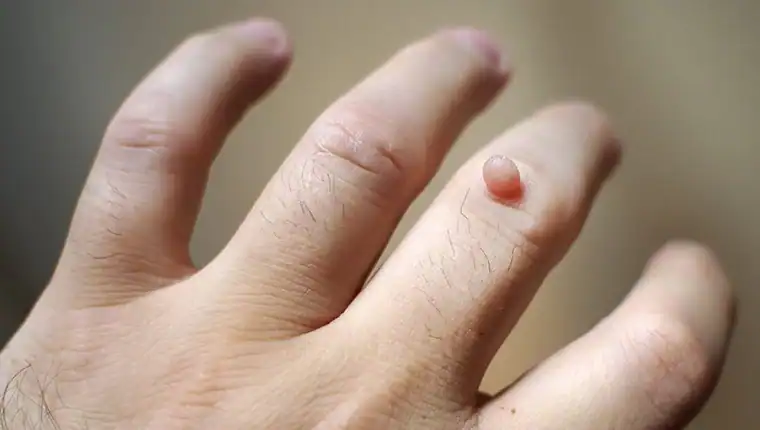 Cryotherapy For Warts And Also Verrucas 1 Image of blemish that Cryotherapy Bournemouth can remove with Lipo 360.