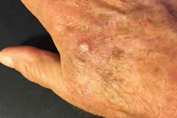 Image of Actinic keratoses Bournemouth on a person hand