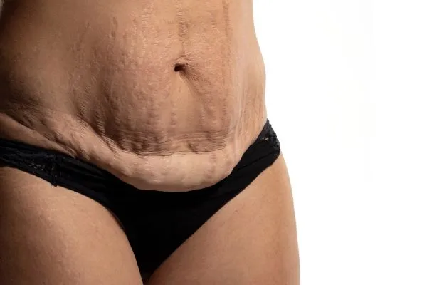 The Science of Skin Tightening 1 The science behind skin tightening Bournemouth picture of a woman's sagging skin on the stomach